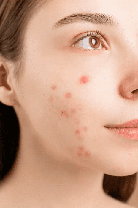skin with blemishes and spots 