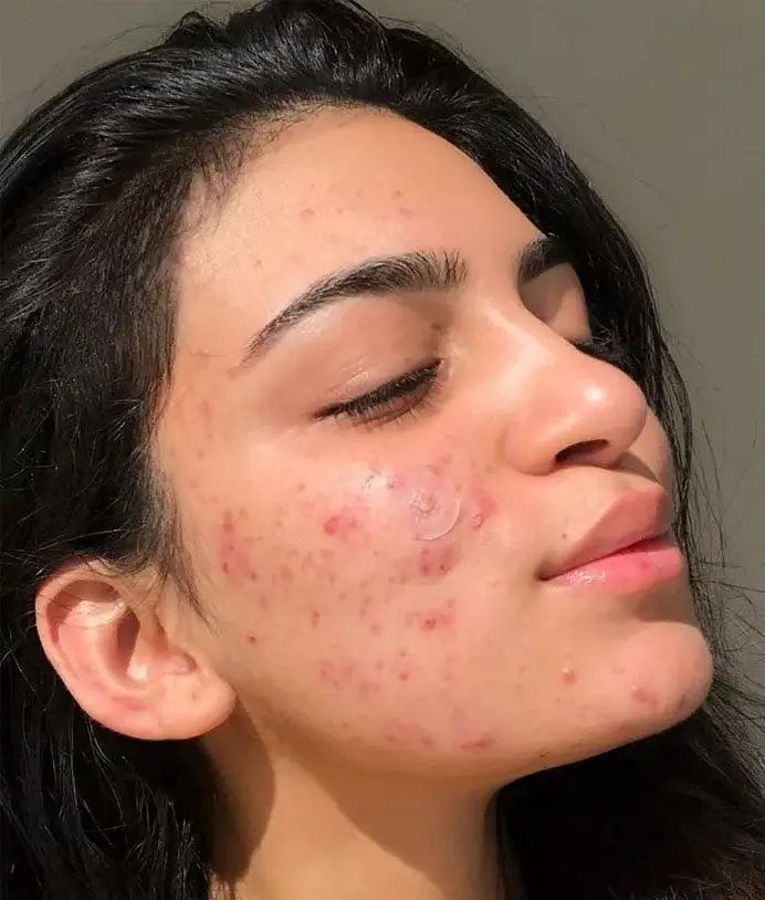 Before Edit Women's face with pimples